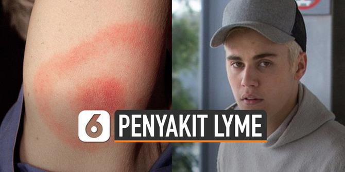 VIDEO: Kenali Lyme, Penyakit yang Diderita Justin Bieber