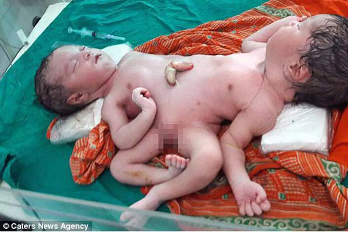 Aneh, Bayi Lahir Kembar Siam Beda Kelamin dalam Satu Tubuh
