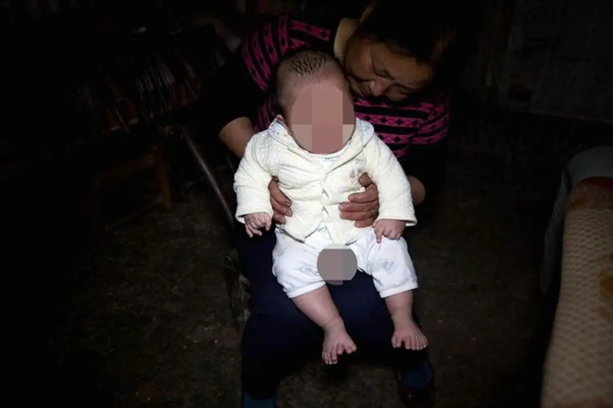 [Bintang] Terlahir 16 Jari, Bayi Ini Jalani Operasi untuk Menguranginya