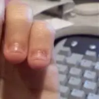 Masih suka mengigit kuku? Bersiaplah merasakan penderitaan-penderitaan hebat ini.