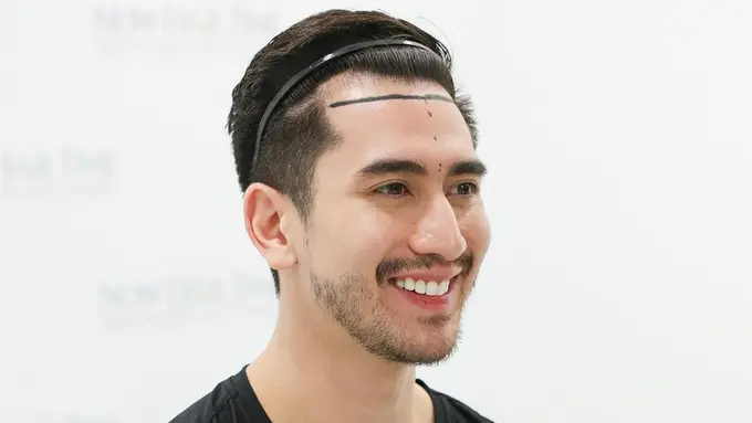 Verrell Bramasta Tampil Botak Usai Transplantasi Rambut, Curi Perhatian