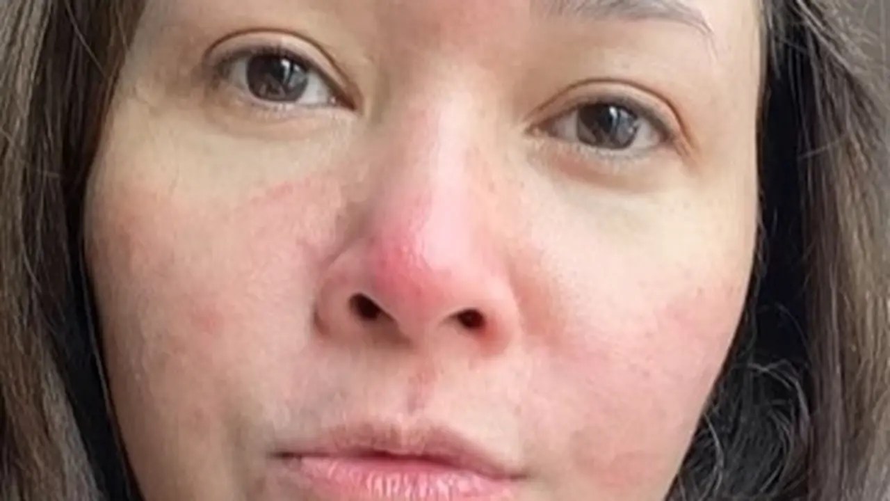 Maia Estianty derita rosacea (Instagram/maiaestiantyreal)