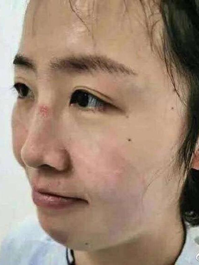 7 Potret Luka Lebam di Wajah Tim Medis Akibat Kacamata Pelindung Selama Perangi Virus Corona