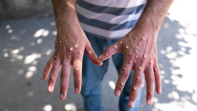 Virus ini termasuk dalam genus orthopoxvirus