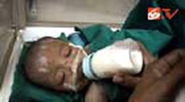 Seorang ibu di Sunter, Jakut, tega menyiksa anaknya yang baru berumur lima bulan hingga menderita patah tulang di bagian tangan dan kakinya. 