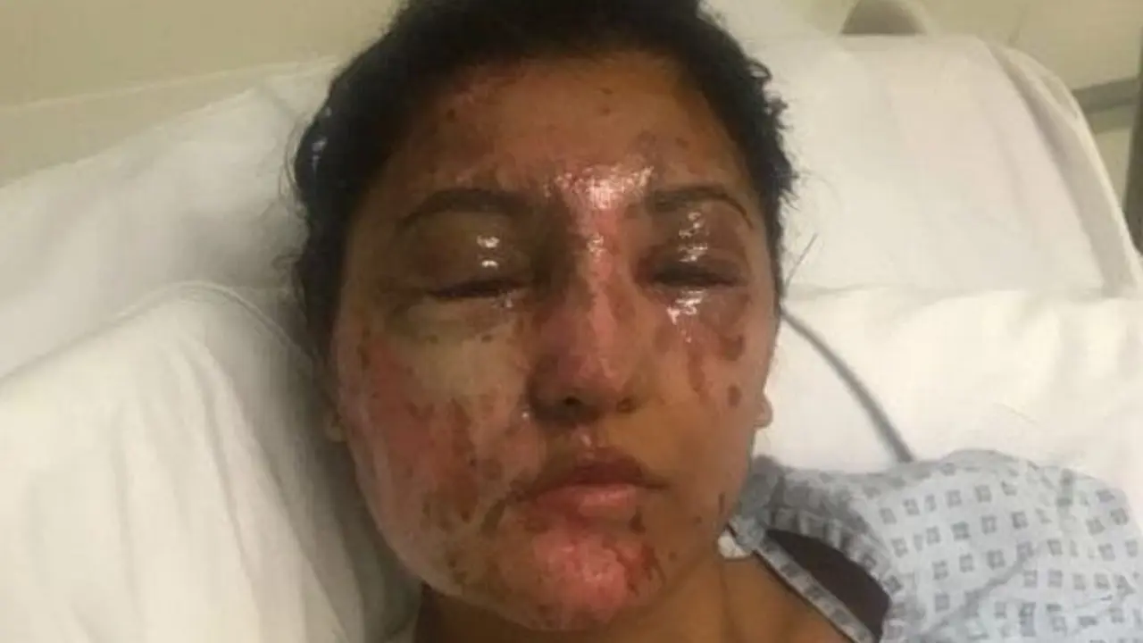 [Bintang] Setelah Disiram Air Keras, Penampilan Wanita Ini Buat Banyak Orang Shock