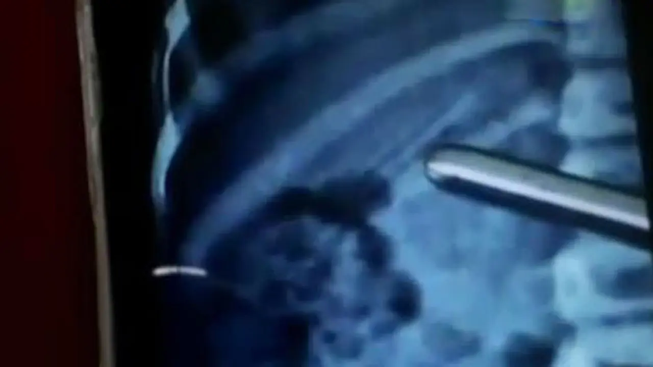 Bocah Ini Menelan Pensil 7 Cm Saat Hilangkan Sisa Bakso di Gigi 