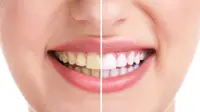 Ketika mendapati gigi Anda tampak kuning setiap kali tersenyum terkadang dapat membuat Anda sangat frustasi