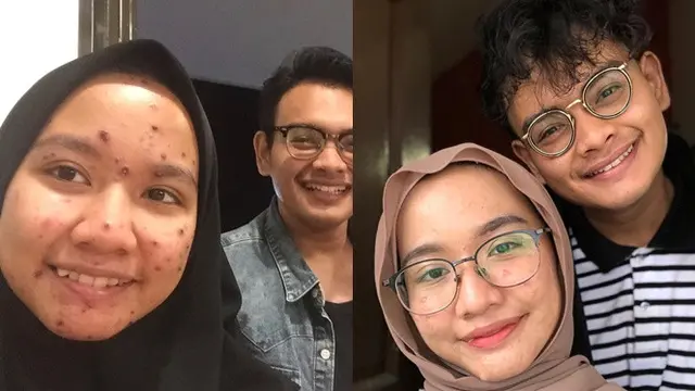 Tetap Setia dengan Pacar yang Berjerawat, Pria Ini Tulis Pesan yang Menyentuh