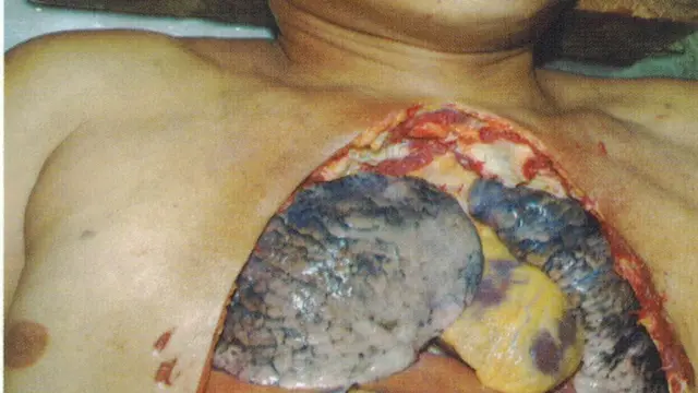 Masihkah Anda Berani Merokok Setelah Melihat Gambar Ini?