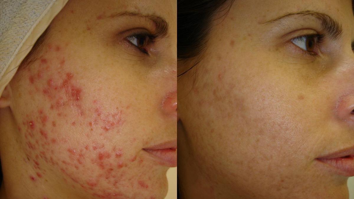 Dari Aspirin Hingga Air Kencing, Ini 5 Obat Jerawat Paling Aneh