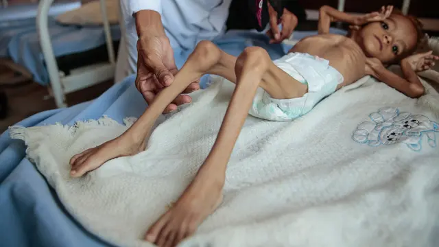 Begini Kondisi Anak-Anak Yaman Penderita Gizi Buruk