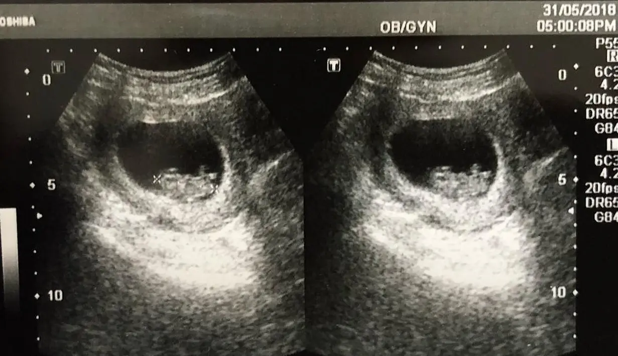 Terbaru, Desta kembali membagikan kabar bahagia dengan mengunggah kembali foto hasil USG. Bahagia bukan main, pasalnya anak ketiganya ini berjenis kelamin laki-laki. Mengingat dua anak sebelumnya berjenis kelamin perempuan. (Instagram/desta80s)