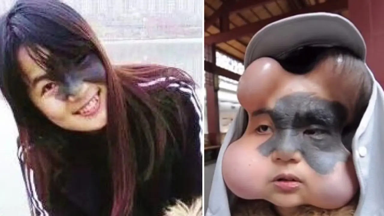 Kanker Tahi Lalat, Wajah Gadis Ini Berubah Mirip Boneka Anime