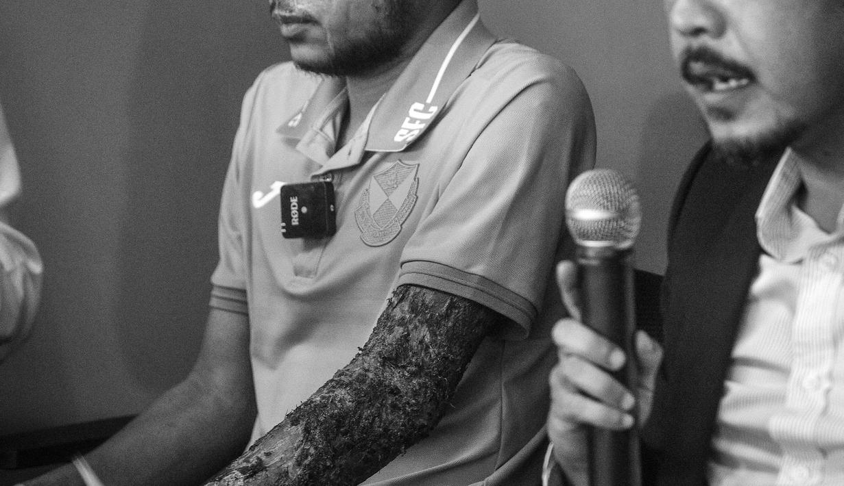 Pemain Malaysia, Faisal Halim saat jumpa pers pemusatan latihan Selangor FC di Padang SUK Shah Alam, Kamis (13/6/2024). Terlihat luka bakar di sejumlah bagian tubuhnya akibat insiden penyiraman air keras oleh orang yang tak dikenal pada 5 Mei 2024. (AFP/Arif Kartono)