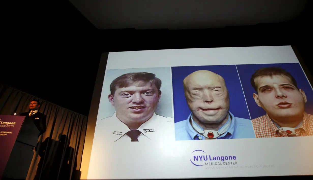 Seorang ahli bedah plastik  Dr Eduardo Rodriguez D memberikan keterangan pers terkait suksesnya transplantasi wajah dari Patrick Hardison di Langone Medical Center NYU, New York, Amerika Serikat, (16/11/2015). (REUTERS)