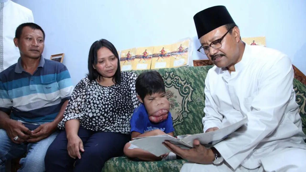 Bintang, Penderita Tumor Gusi Asal Blitar