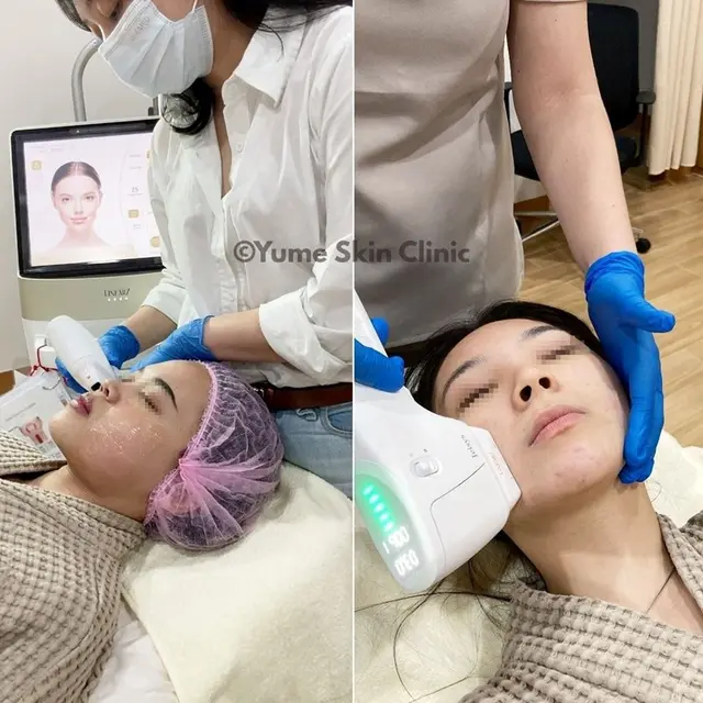 Kenalan dengan LINEAR Z yang Jadi The Next Level HIFU, Solusi Awet Muda Tanpa Operasi