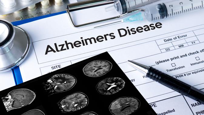Penyakit Alzheimer (Sumber: iStockphoto)