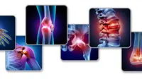 Ilustrasi osteoporosis. (Shutterstock)