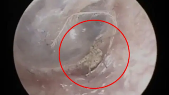 Rasakan Sakit di Telinga, Ternyata Laba-Laba Bersarang di Dalamnya