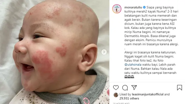 Anak Mona Ratuliu alami Dermatitis Atopik