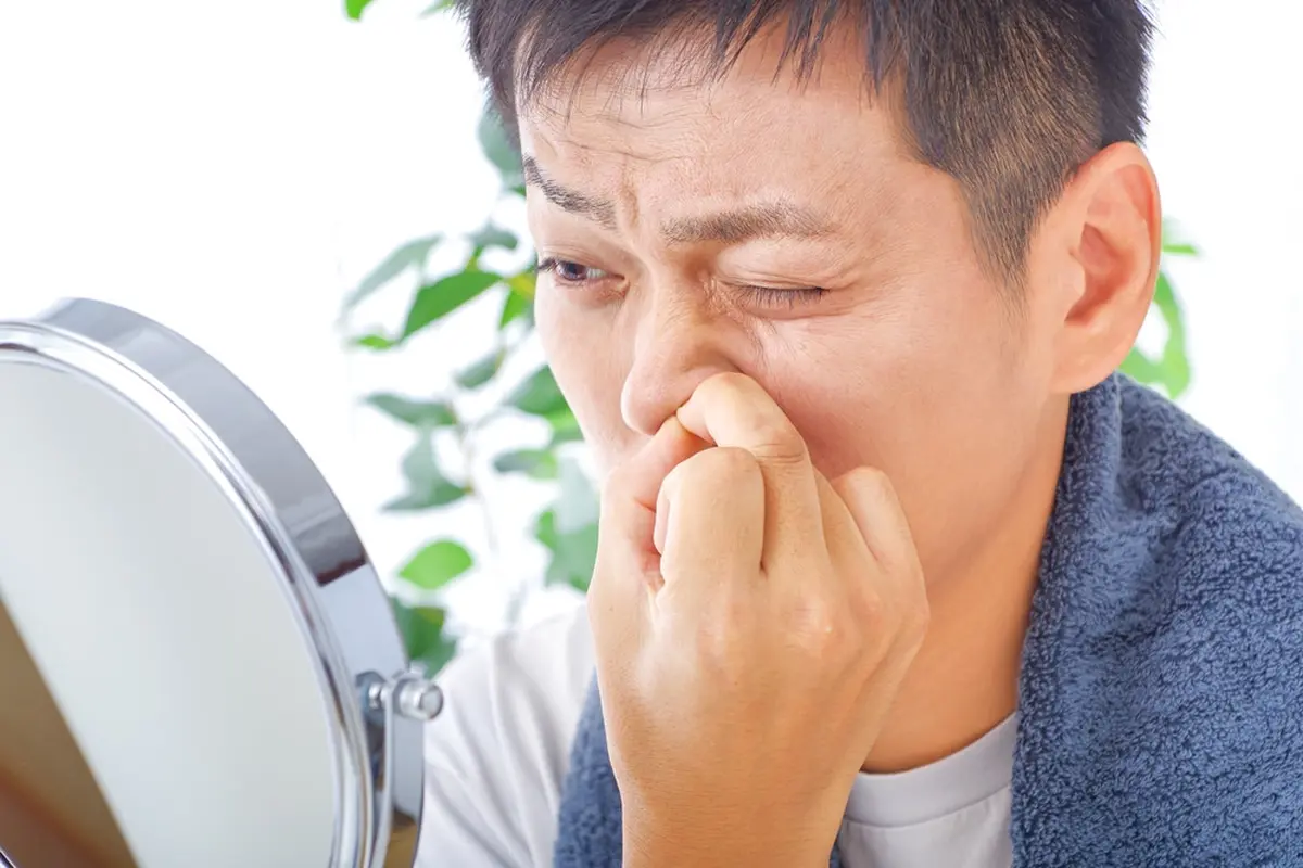 Jerawat di Hidung Pria, Ini Penyebab dan Cara Mengatasinya