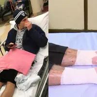 Seorang remaja Australia kakinya berdarah-darah lantaran dimakan kutu laut. Apa itu? | Sumber Foto: news965.com