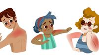 Ilustrasi sunburn, luka bakar akibat sinar matahari. (Image by pikisuperstar&lt;/a&gt; on Freepik)