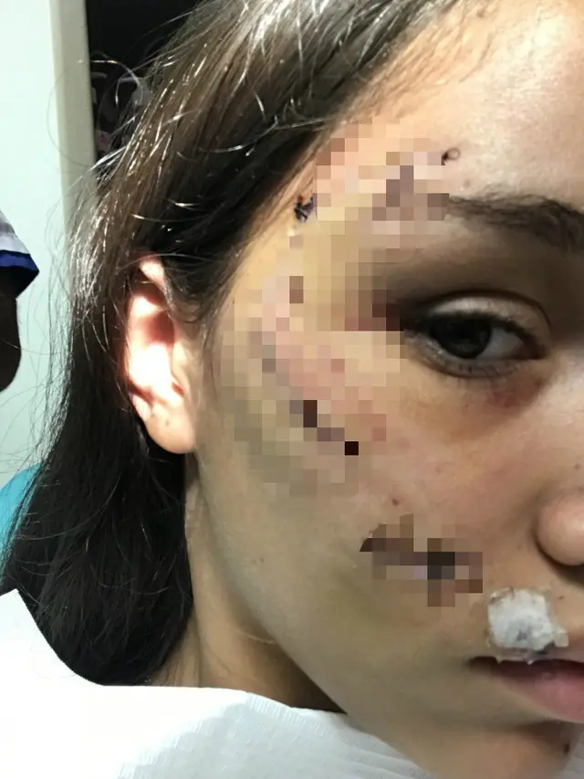 gadis digigit anjing peliharaan