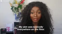 Shalom Nchom, Gadis Wajah Terbakar yang Tampil Cantik dengan Keajaiban Makeup