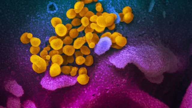 Gambar mikroskop elektron pemindaian ini menunjukkan coronavirus baru (kuning) di antara sel manusia (biru, merah muda dan ungu).