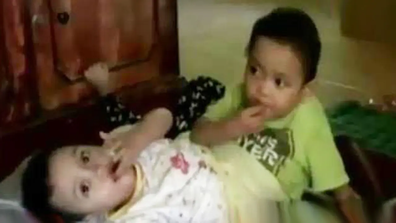 VIDEO: 2 Balita Kembar Siam Ini Hanya Punya Sepasang Kaki