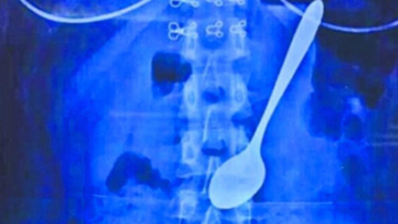 Sendok Sepanjang 14 cm Terperangkap di Tubuh Mahasiswa