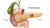 Penderita kanker pankreas harus mendapatkan asupan magnesium yang cukup untuk mengobatinya dan juga pencegahannya.