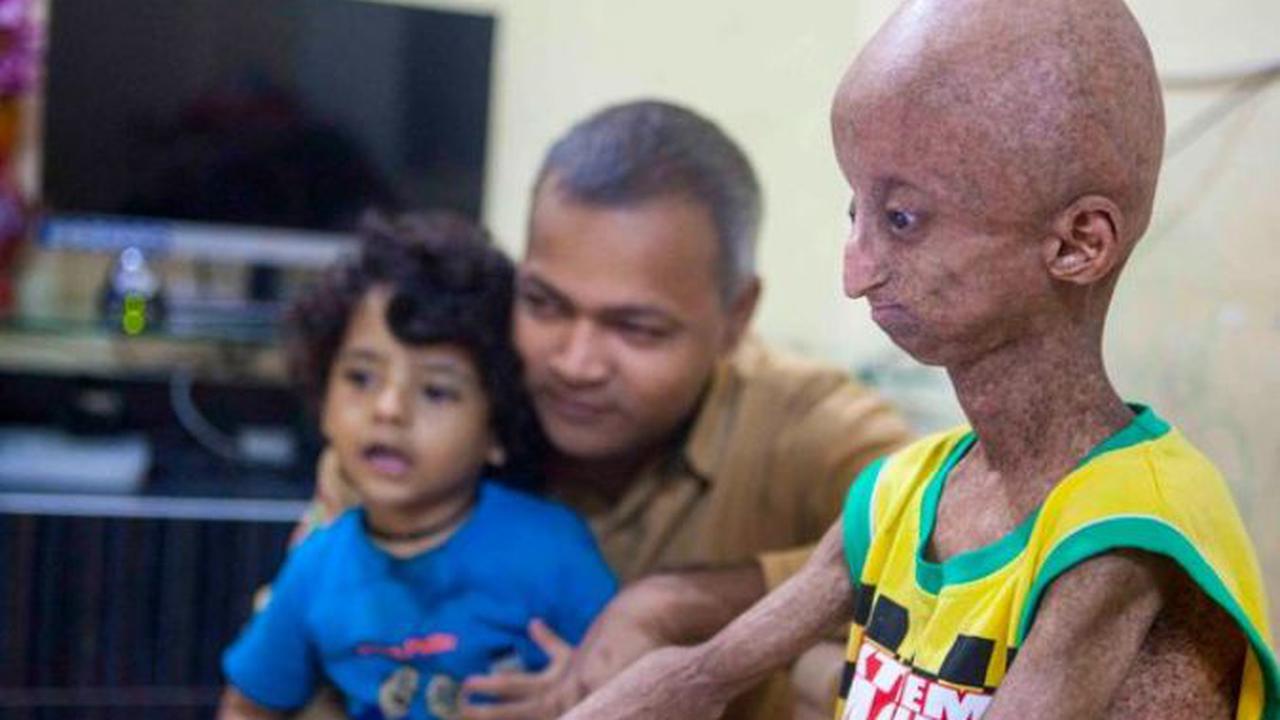 Remaja 14 Tahun Ini Menua dengan Sangat Cepat