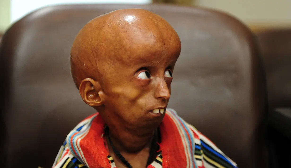 Rupesh Kumar (21) mencari bantuan dana untuk penyakitnya di Kantor Magistrat Allahabad, India, Selasa (2/5). Rupesh yang memiliki bobot 19 kilogram ini bisa saja penyintas progeria tertua di dunia setelah Leon Botha dari Afsel. (SANJAY KANOJIA / AFP)
