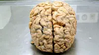 Seorang pria kehilangan 90 persen otaknya, tapi menjalani kehidupan yang normal. Bagaimana bisa? (Sumber Michael Horton/Flickr via Science Alert)