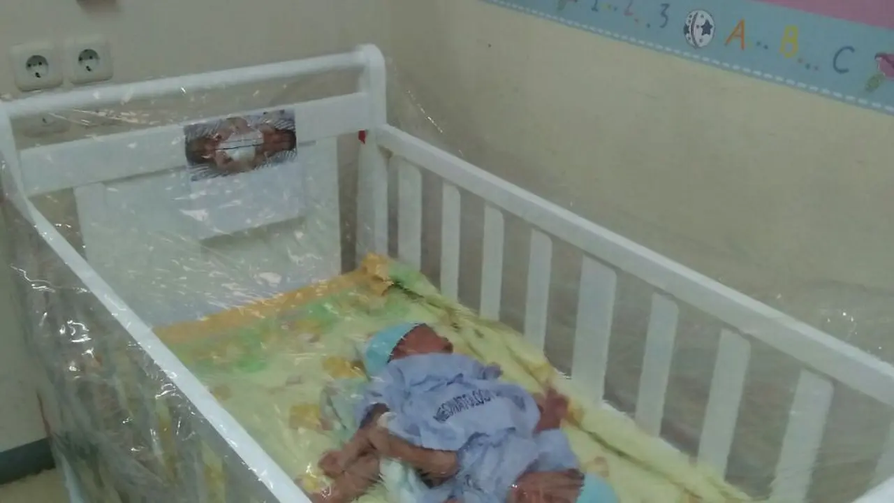 Bayi Kembar Siam Dempet
