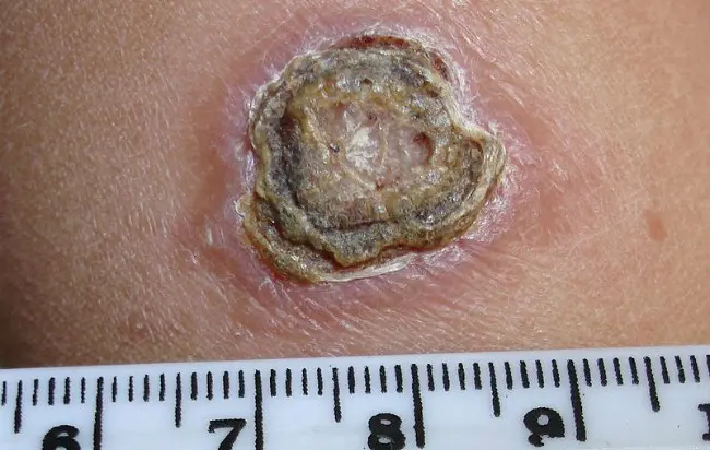 Cutaneous leishmaniasis. (Sumber Wikimedia/Abanema)