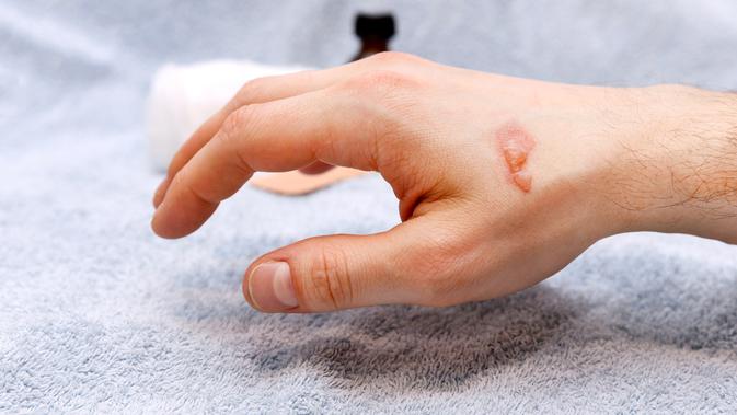 5 Cara  Mengobati  Luka Melepuh dengan  Bahan Alami Hot 