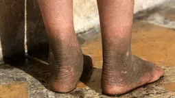 Doaa, bocah berumur lima tahun memperlihatkan kulit kakinya yang berubah akibat dampak bom kimia di Qayyara, Irak, (12/11). Militan ISIS telah membakar pabrik kimia yang menyebabkan tersebarnya zat-zat kimia ke warga sekitar. (REUTERS/Air Jalal)