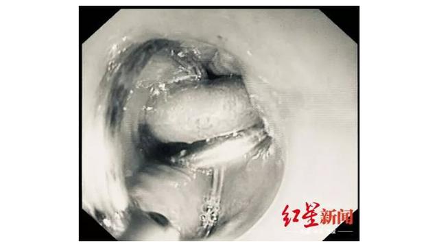 Akibat Mabuk Berat, Pria Ini Tak Sadar Telan Kunci Rumah