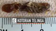 Dokter di Inggris mengklaim telah mengeluarkan kotoran telinga terpanjang di dunia dari seorang pria yang lakukan pemeriksaan.