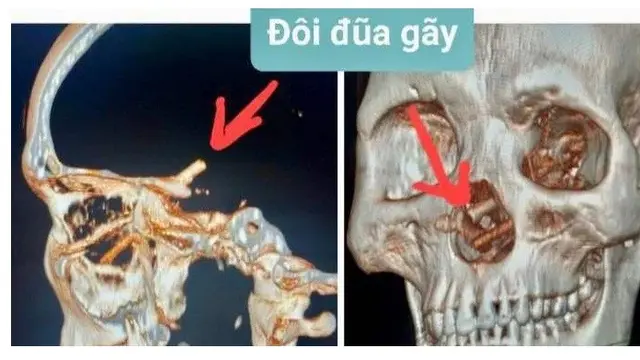 Sumpit di tengkorak seorang pria