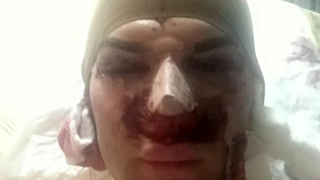 Operasi Plastik 42 Kali, Hidung Pria Mirip Ken Membusuk