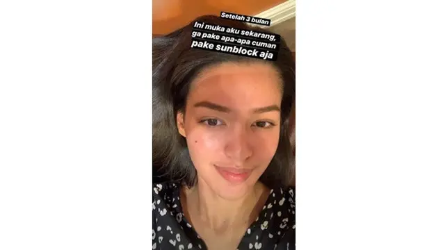 Menangis Karena Wajah Rusak, Ini 6 Potret Terbaru Susan Sameh