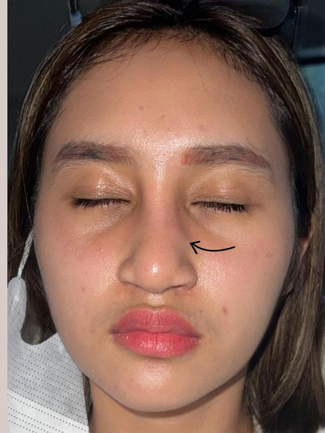 Sempat Oplas, Ini 6 Potret Permesta Dhyaz Anak Farida Nurhan Alami Infeksi Implan