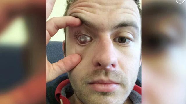 Tak Lepaskan Lensa Kontak Saat Mandi, Pria Ini Alami Kebutaan