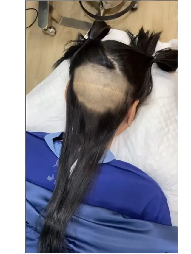 6 Potret Lucinta Luna Transplantasi Rambut di Thailand, Sempat Curhat saat Dibotaki